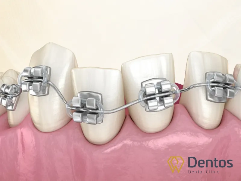 Đối với các trường hợp răng khấp khểnh, niềng răng là phương pháp hiệu quả